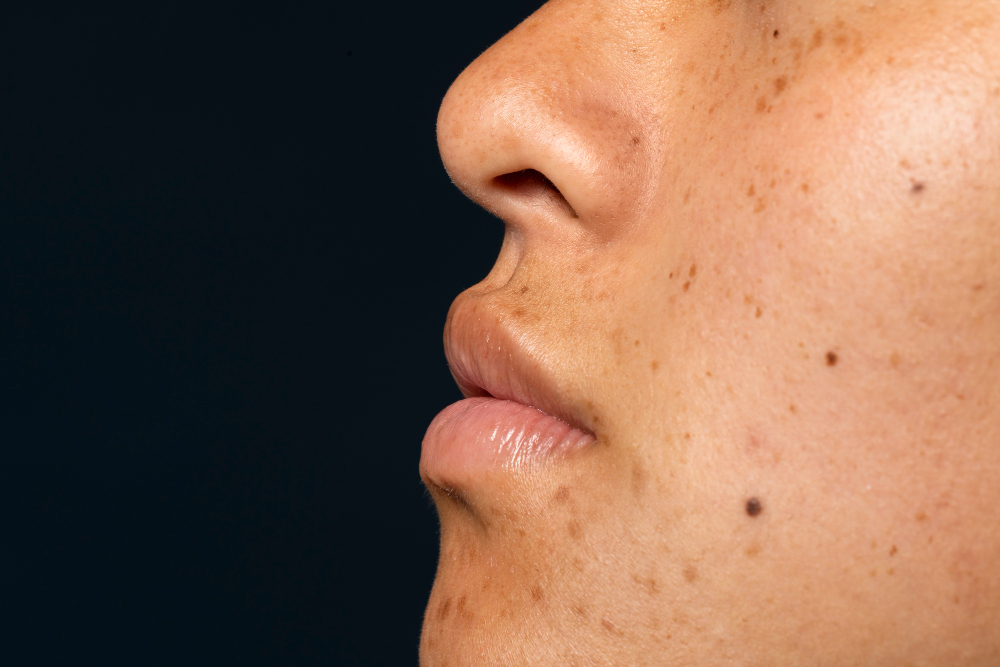 Kenapa Flek Hitam Tidak Hilang Meski Sudah Pakai Skincare?